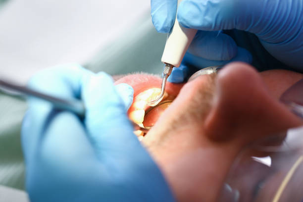 Best Emergency Wisdom Teeth Removal in Port Ludlow, WA